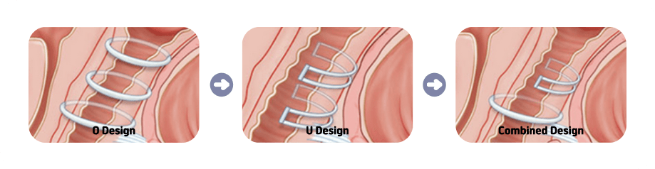 Implant vaginoplasty designs: O design, U design and combined design
