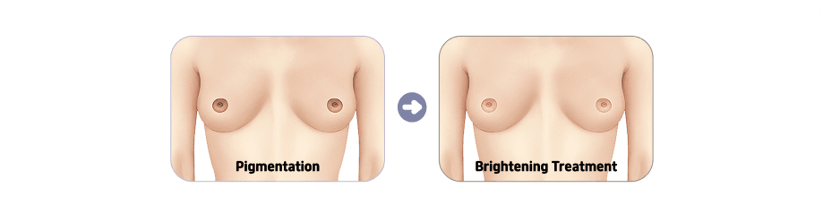 Nipple and areola brightening: pigmentation before and after brightening treatment