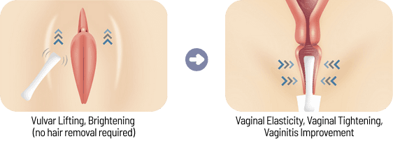 SonoCare treatment areas