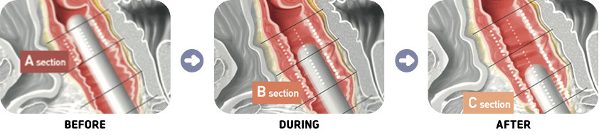 Zeal Thera treatment process: the HIFU probe treats sections A, B and C of the vaginal wall