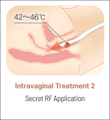 eleVAVA intravaginal treatment step 2: Secret RF application
